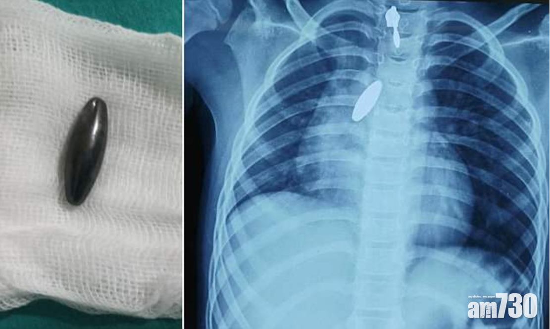 肺卡磁鐵 強力攝石吸出