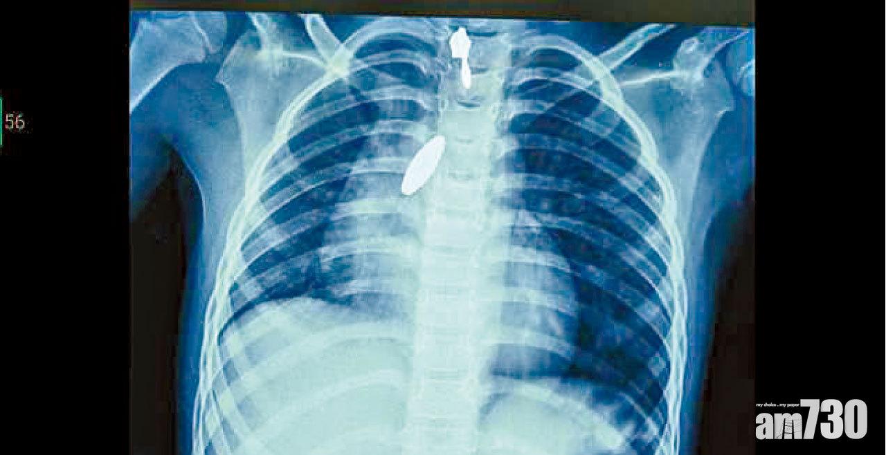 肺卡磁鐵 強力攝石吸出