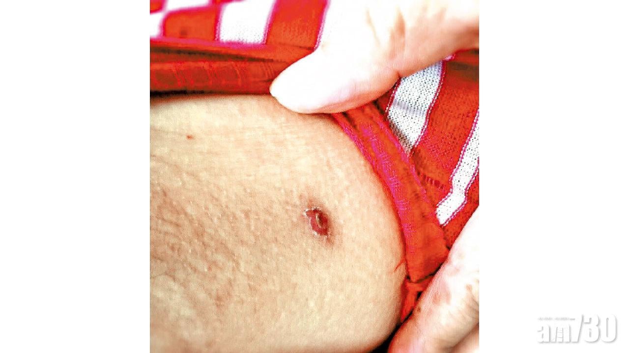 死亡率達六成 花蓮台東郊遊提防恙蟎叮咬