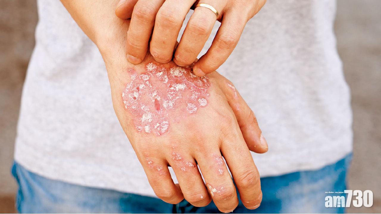 銀屑炎症重 心血管病高危