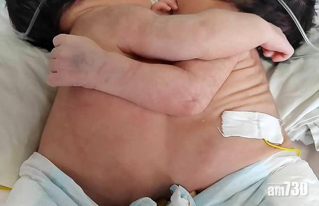 【求天憐憫】連體女嬰「永遠相擁」共用心肝 母盼外國醫生施援