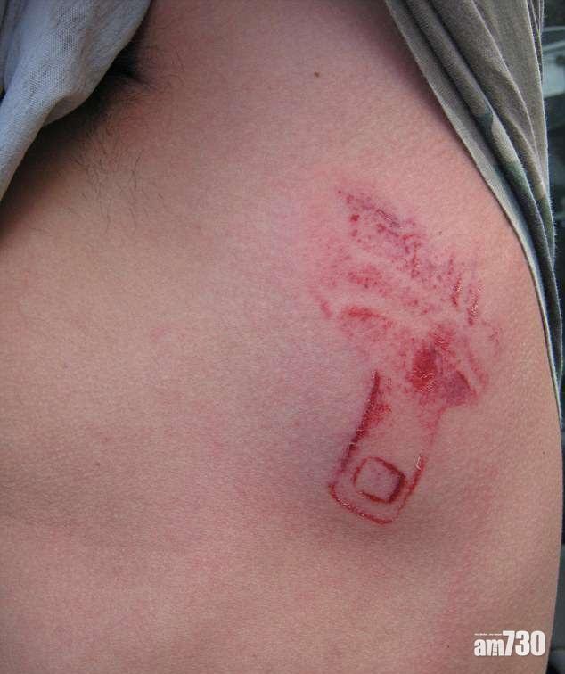 膚烙扣印成罪證