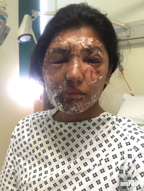 【逆境總會過】去年生日被淋鏹毀容 嫩模一年後還原靚樣