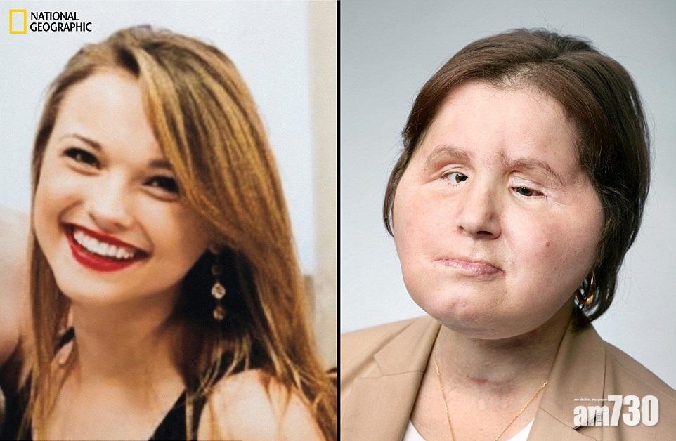 吞槍毀容 少女換臉重生