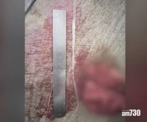 【慎入】湖北婦乳房取出4條活蟲 疑因長期食未熟肉