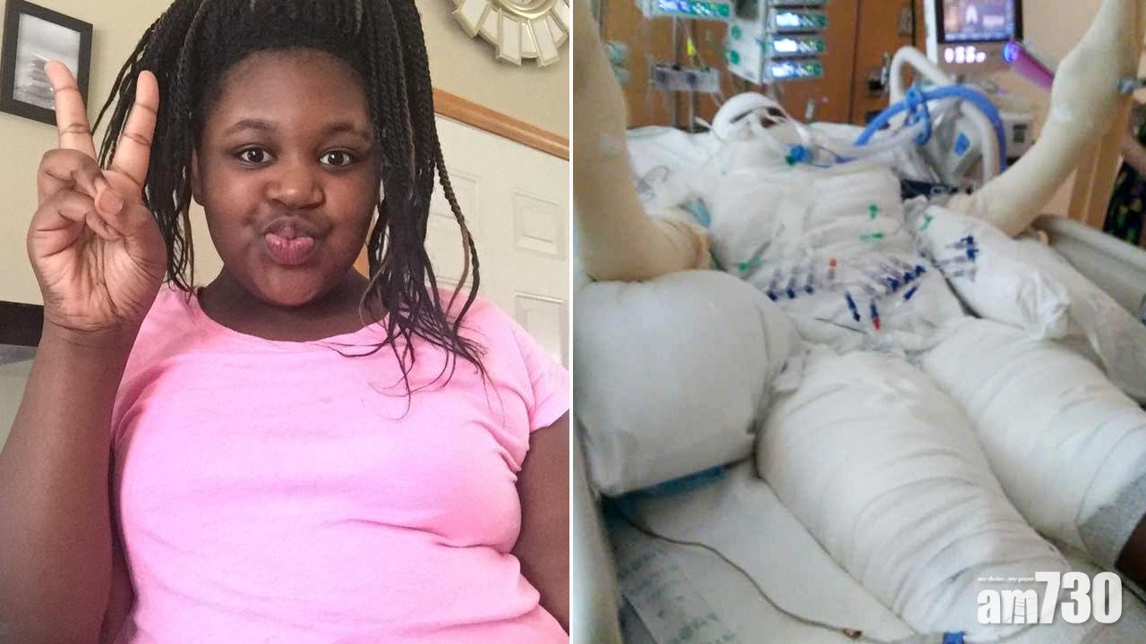 【切勿模仿】12歲女玩YouTube火燒身挑戰慘變火球