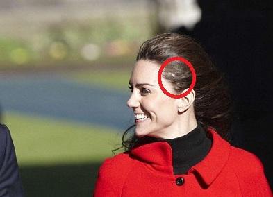 【王室小秘密】凱特髮下有疤痕  醫生揭原因