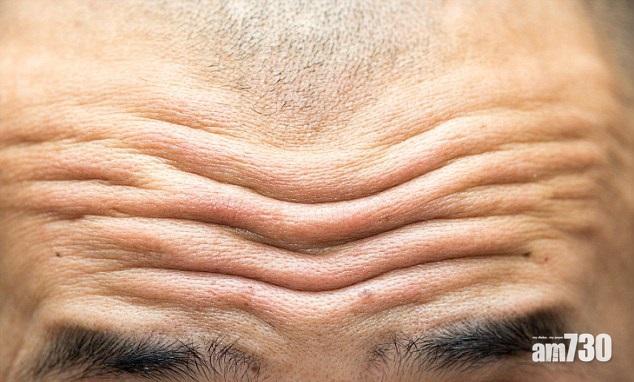 額紋深 心臟病風險高