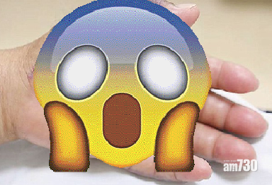 71歲老翁食魚生 手掌變成……