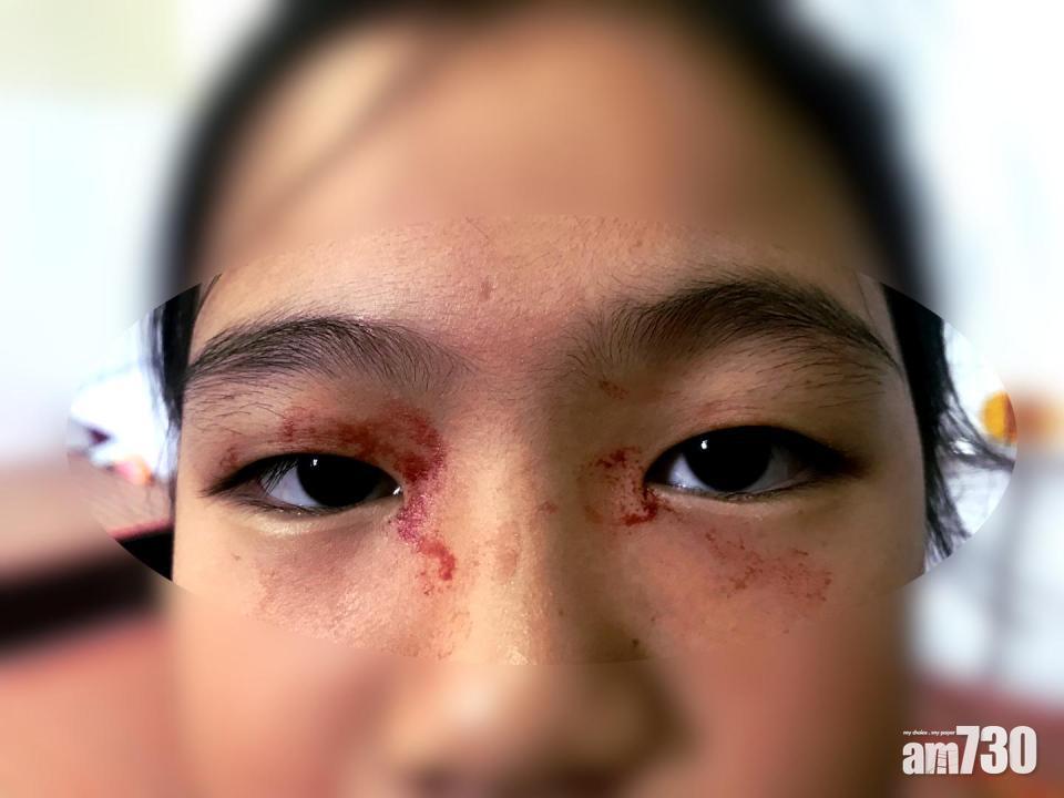 女童患罕見病 考試壓力大到流「血汗」