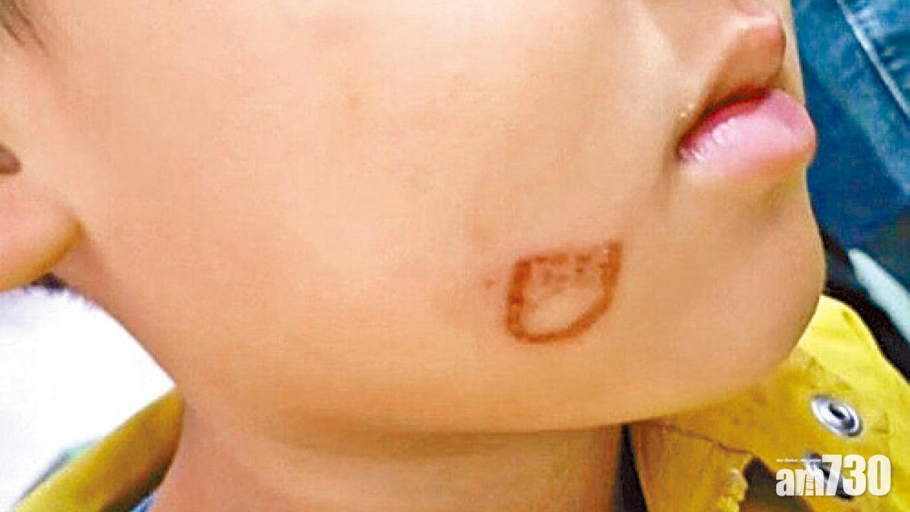 嫌不聽話用火機恐嚇 幼師燙傷男童 罰拘留15天