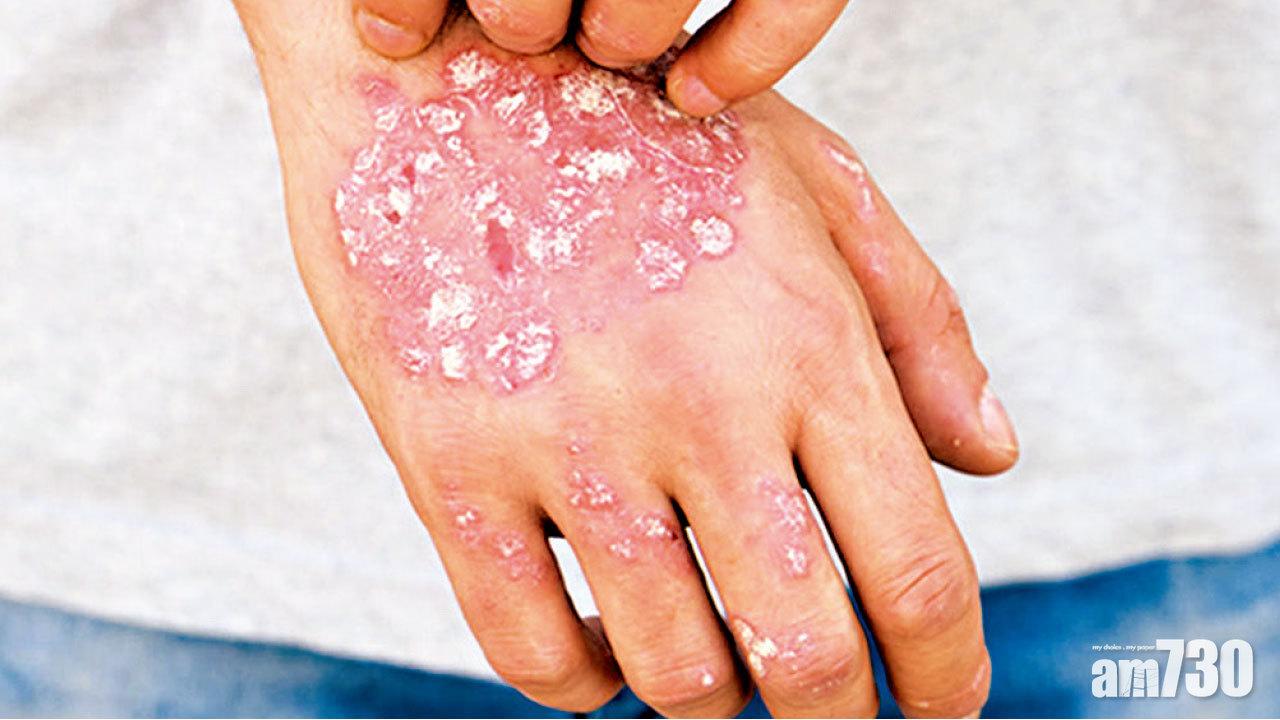 定期檢查銀屑病及早發現共病 