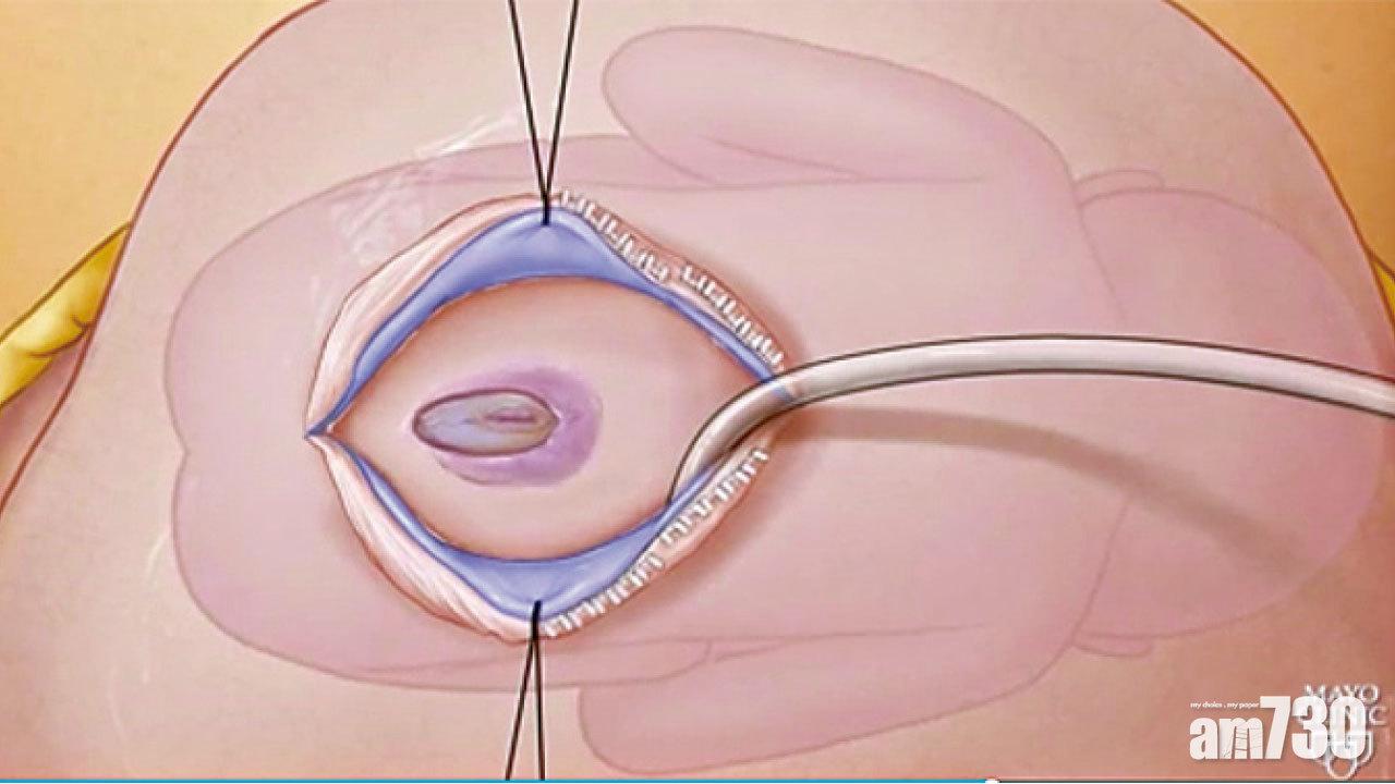 子宮內修脊裂救胎兒