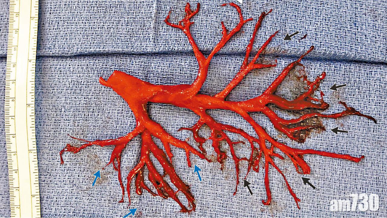 心臟衰竭病人 咳甩肺 吐出支氣管狀血塊