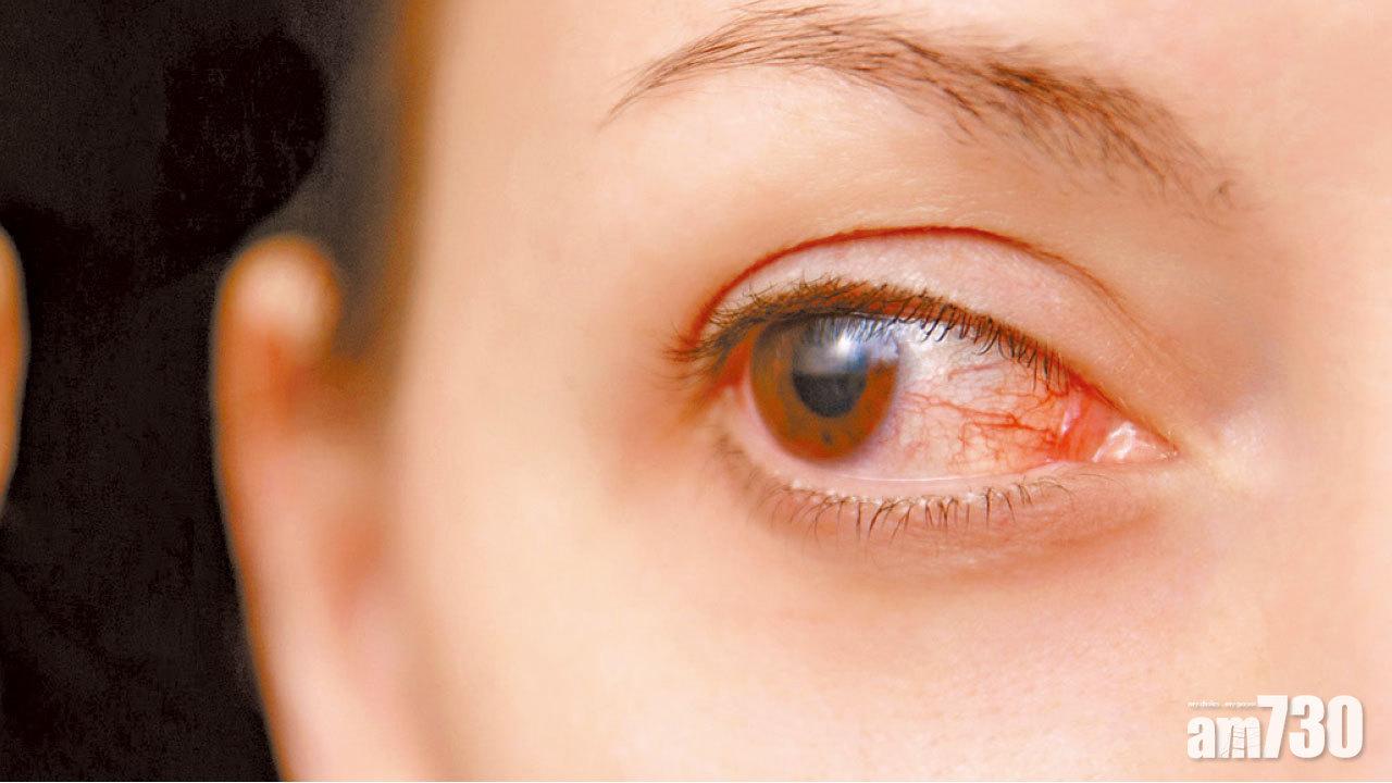 眼凸遭歧視 手術治眼疾兼重拾自信