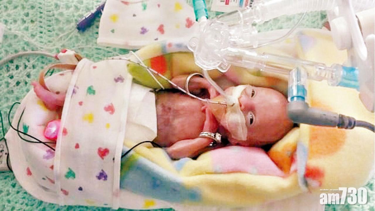 早產存活之冠 大步檻到4歲