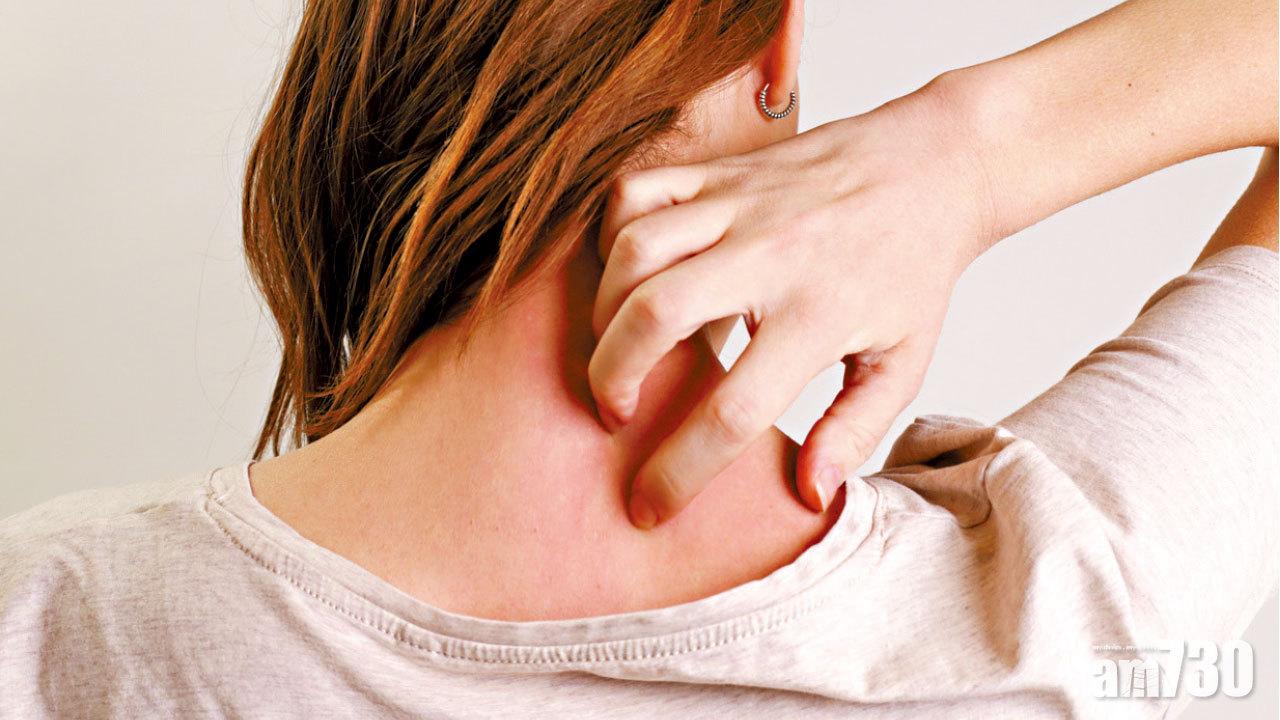 銀屑病濕疹 易混淆