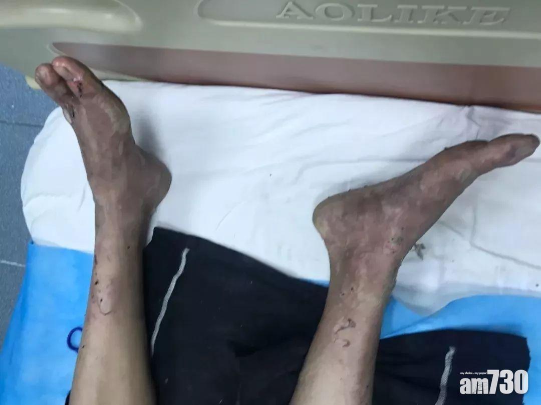 戇男風筒塞被窩取暖 過熱起火燒傷腳