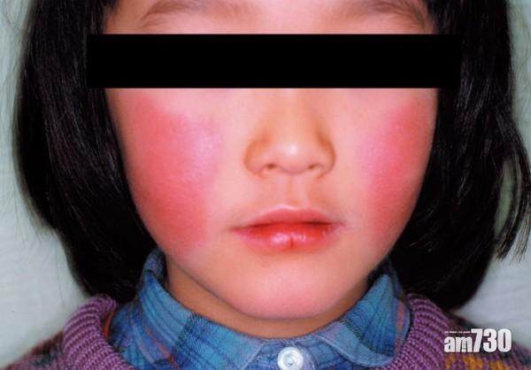 台灣現蘋果病 孕婦險流產