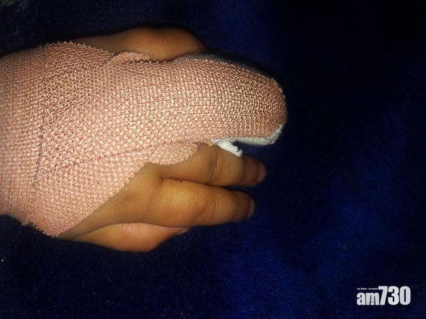 【家長留意】IKEA摺櫈幾近夾斷女嬰手指  醫生︰未必駁得返