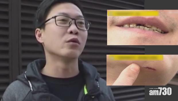 客人因地滑跌斷門牙 K場拒賠：驚佢要用鈦合金補牙