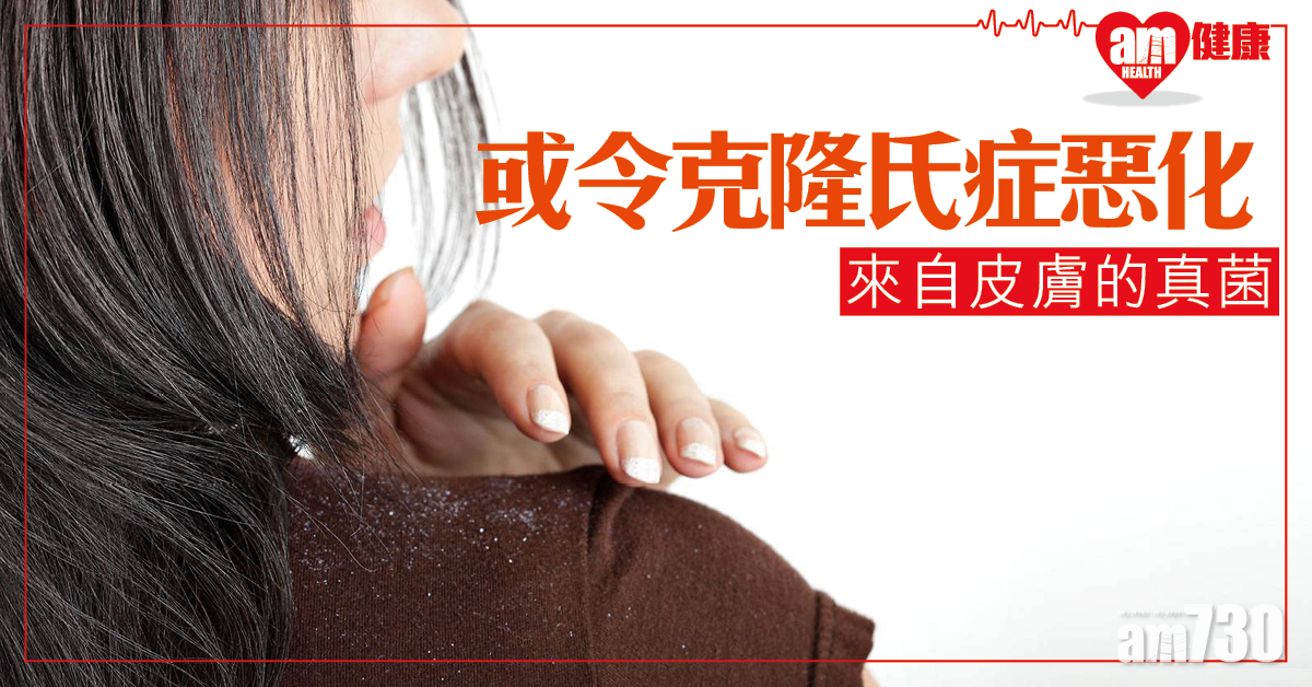 【來自皮膚的真菌】或跟克隆氏症惡化有關