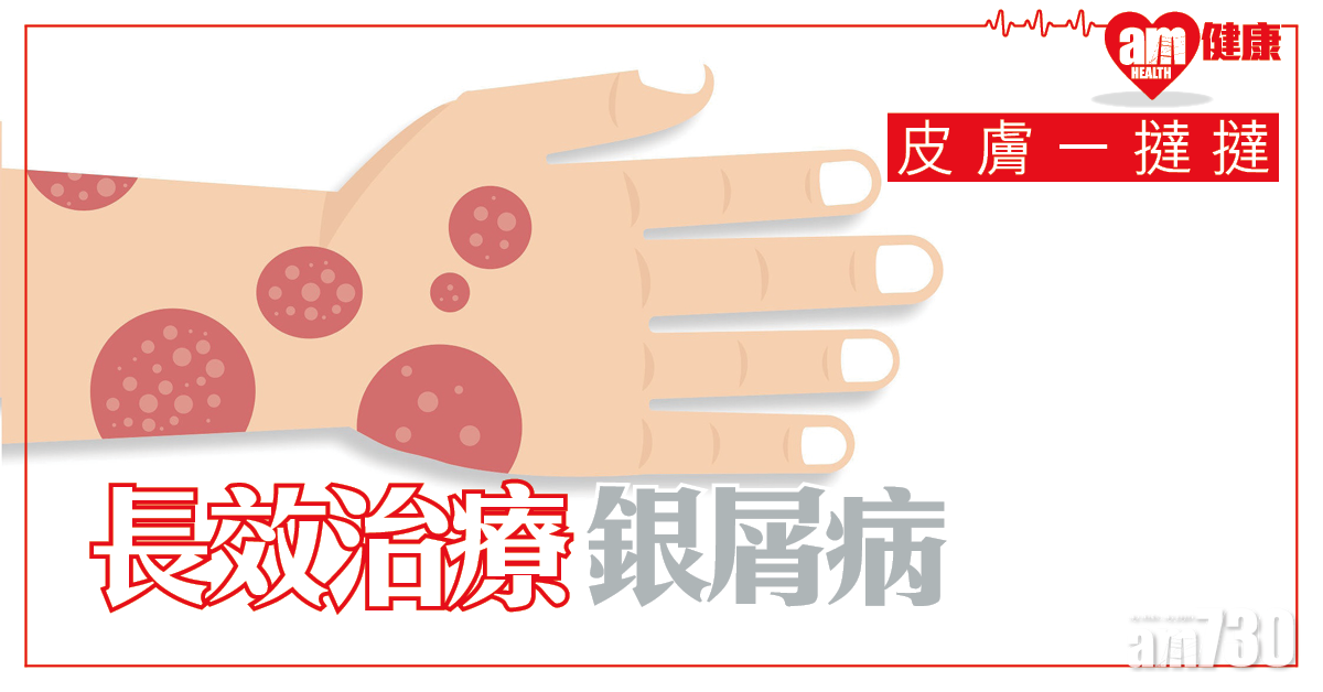 長效治療銀屑病