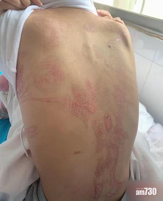 拔罐誤灑酒精燒傷女客背 美容店老闆娘失聯卸責