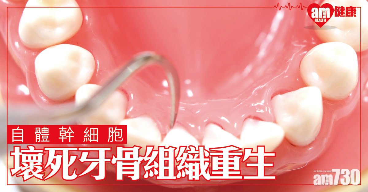「重生」靠自己 ？ 用自體幹細胞  治療壞死牙骨