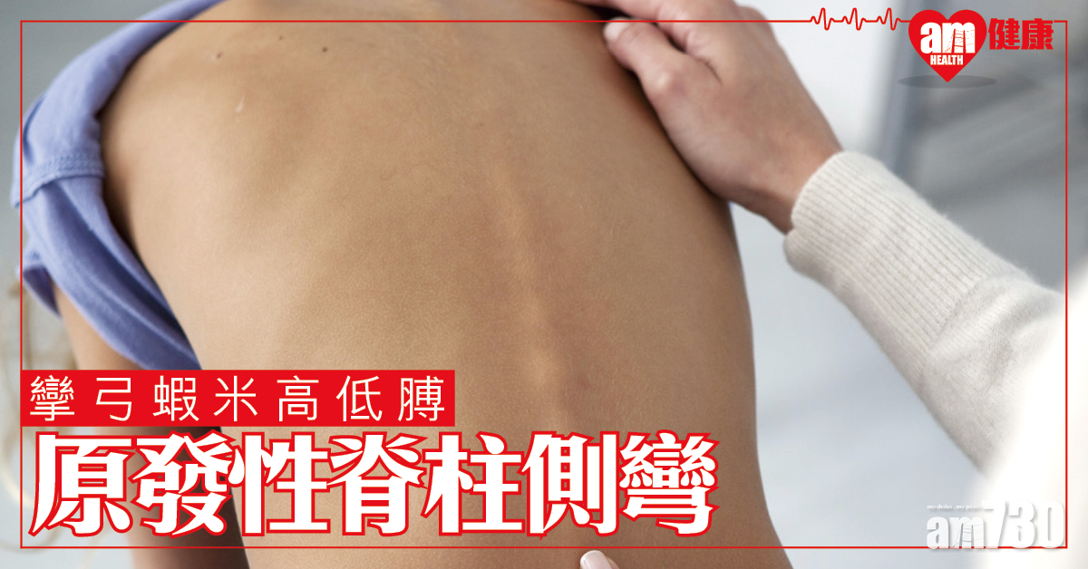 原發性脊柱側彎 早診治或免手術