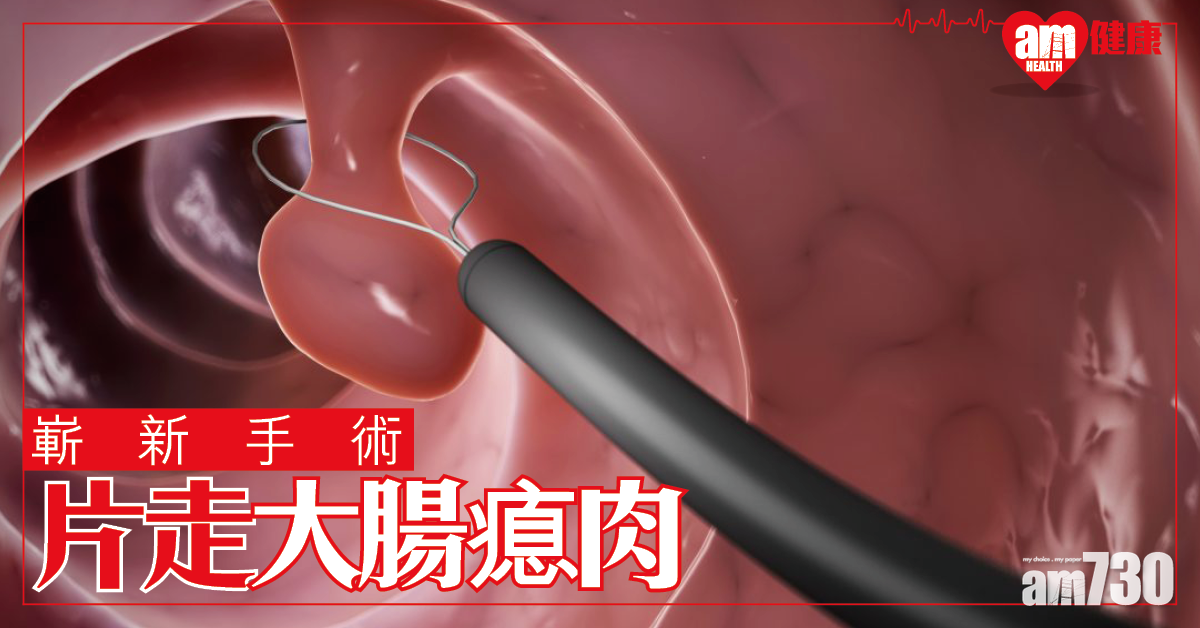 嶄新手術 「片」走大腸瘜肉