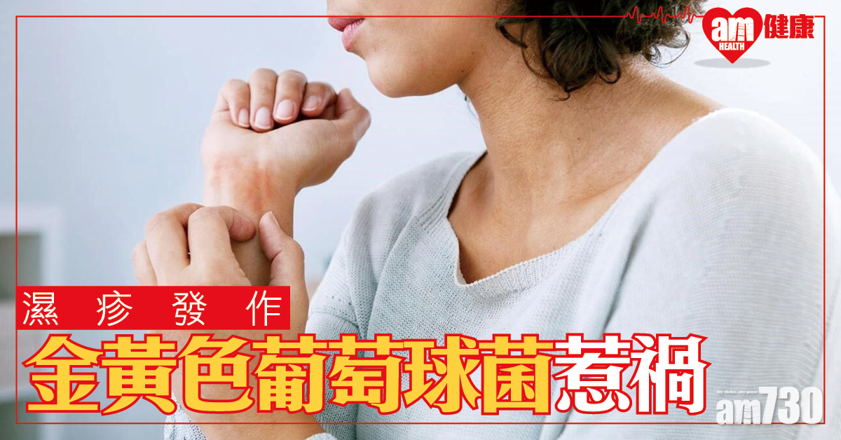 【濕疹發作】美研：或跟皮膚微生物組失衡有關