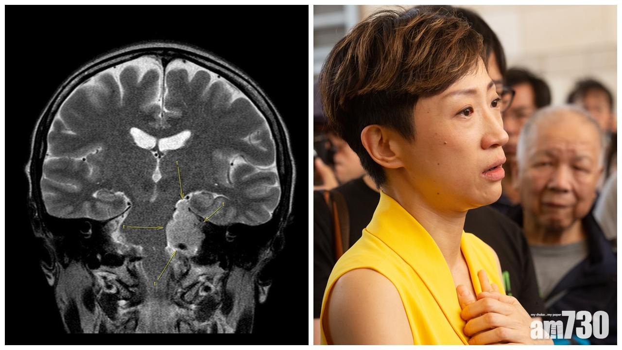 消息：陳淑莊成功切除腦瘤 證實屬良性