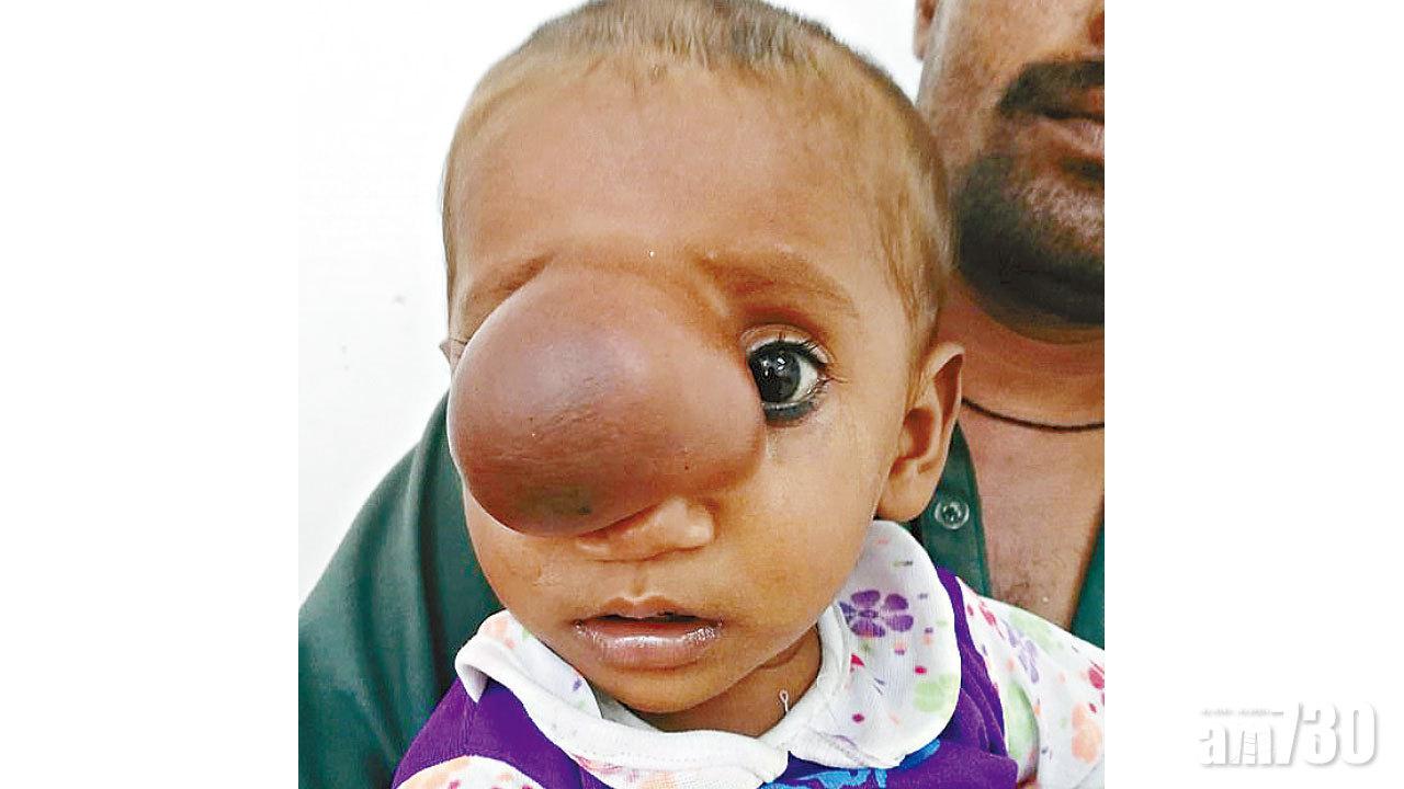 患罕有腦膨出症 疑缺葉酸  男嬰巨瘤壓鼻大如網球
