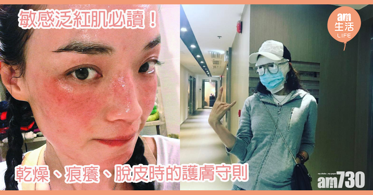 敏感泛紅必讀！ 乾燥、痕癢、脫皮時的護膚守則