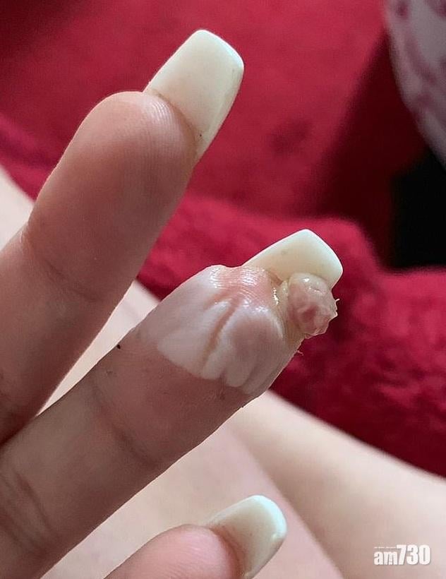 【疑工具不潔】被美甲師粗暴銼傷  20歲女手指生肉瘤含膿傳惡臭