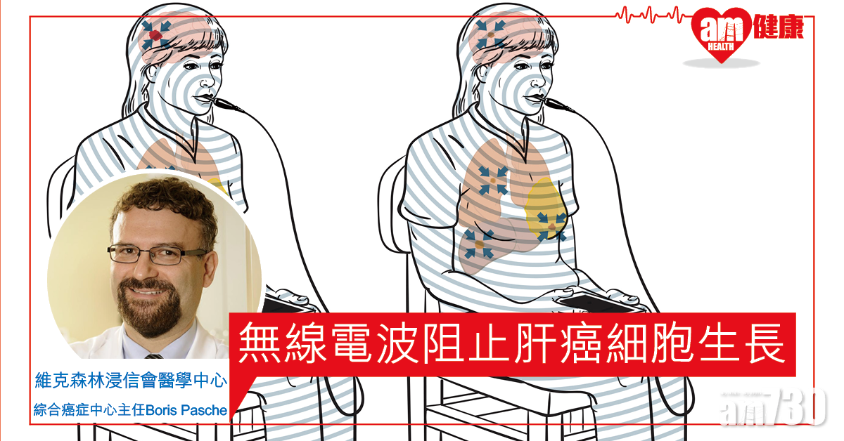 【治癌裝置】研究指非熱無線電波可阻止肝癌細胞生長