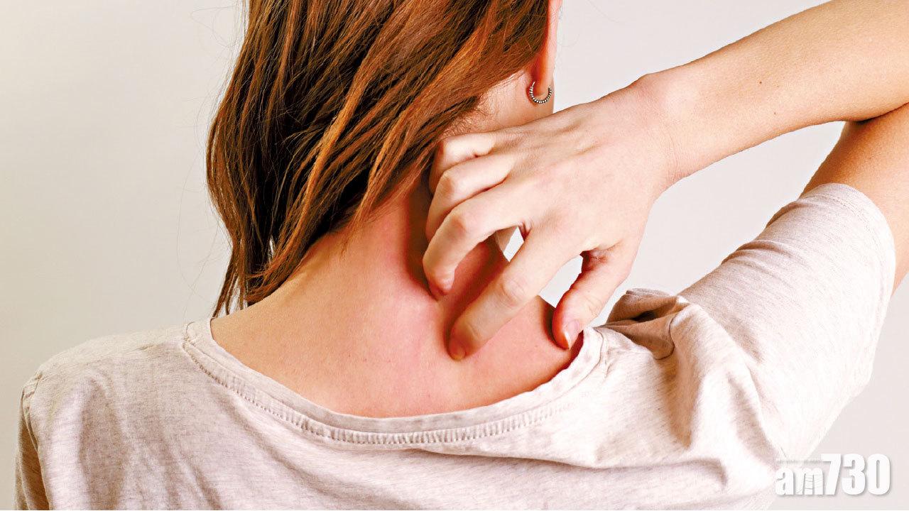 濕疹發作 或跟皮膚微生物組失衡有關