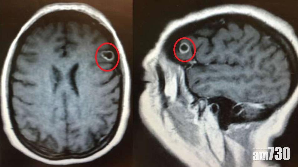 【以為腦瘤】美婦有幻覺唔知自己喺邊  原來腦生蟲
