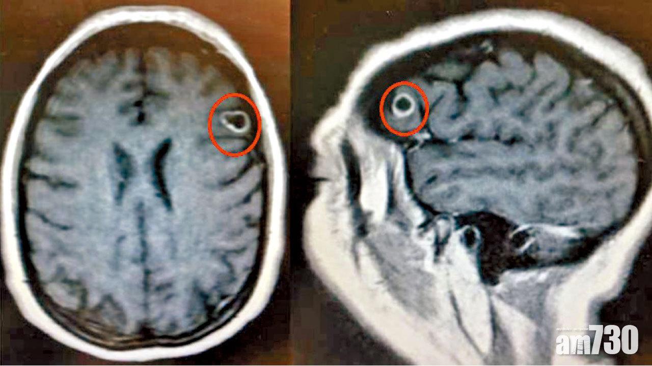 美婦有幻覺  隻手仲識自己郁 以為腦瘤 點知生蟲