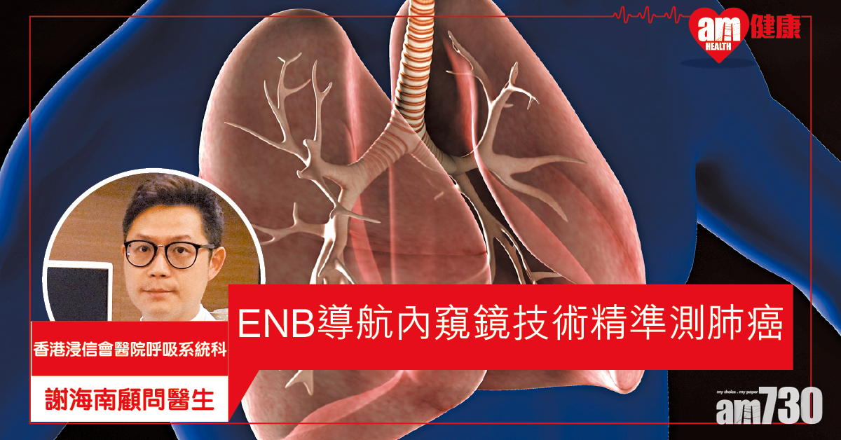 導航內窺鏡技術  精準檢測早期肺癌 