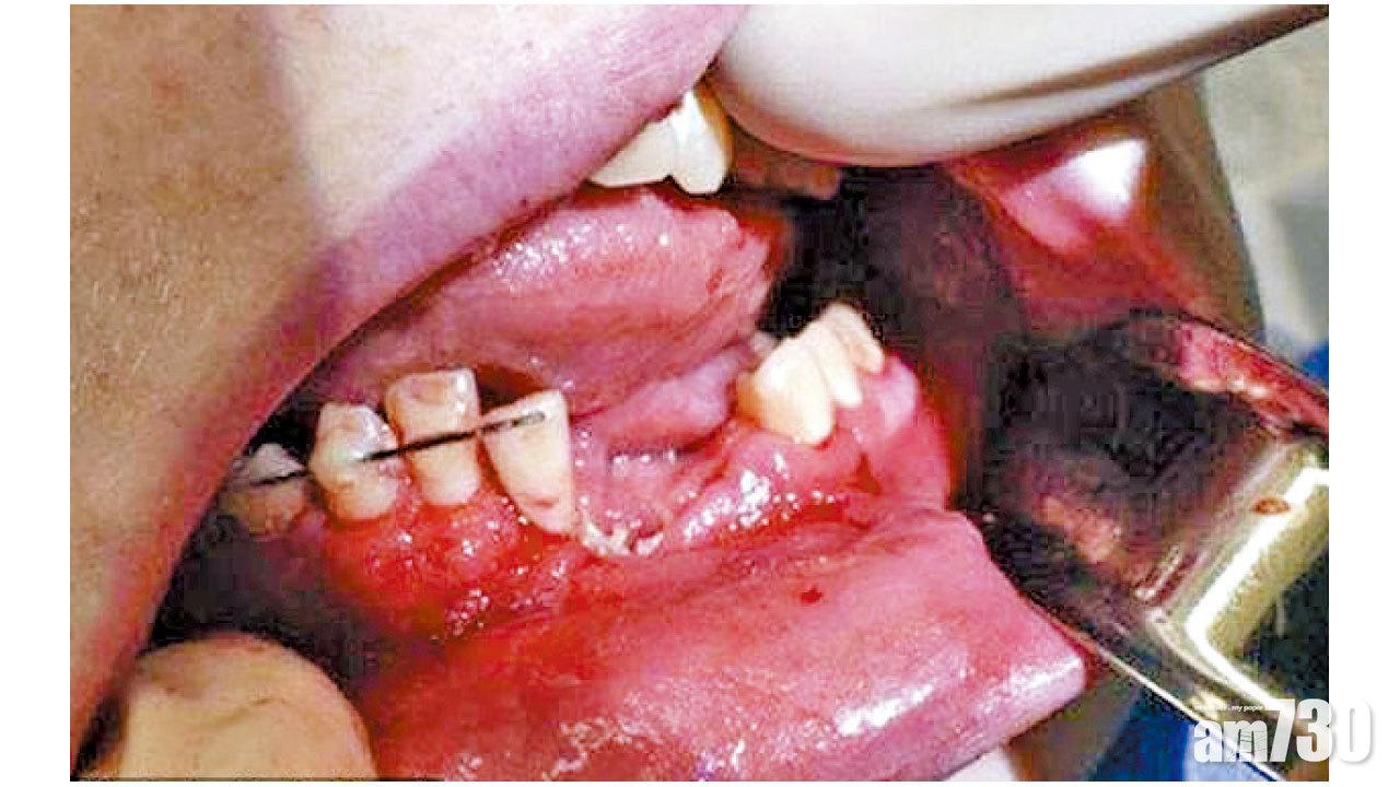 終於戒煙 電子煙爆炸齒崩顎裂