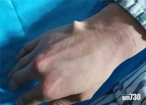 學東寶老闆筷子開啤酒 杭州半月5人插穿手掌求診