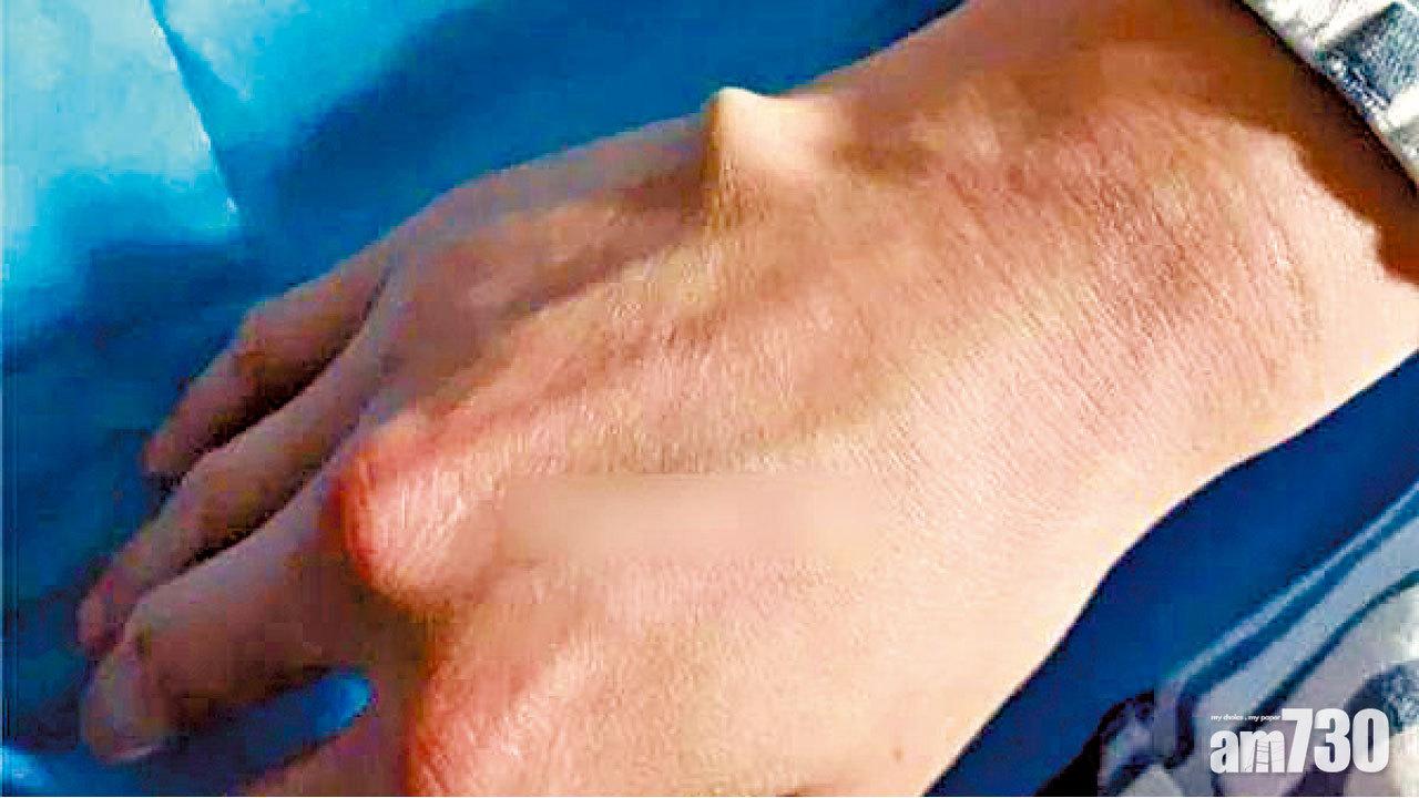 學港食肆老闆筷子開啤酒 杭州半月5人插穿掌心