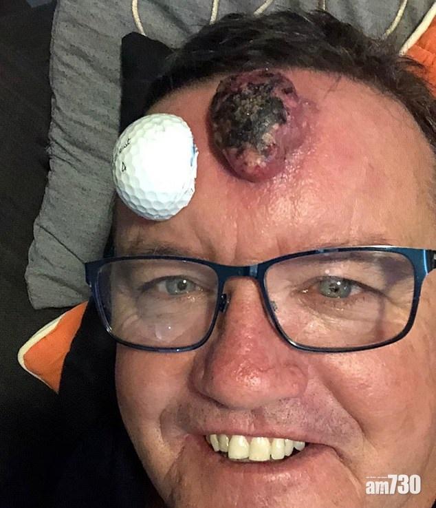 【一唧不可收拾】暗瘡驚變高球癌