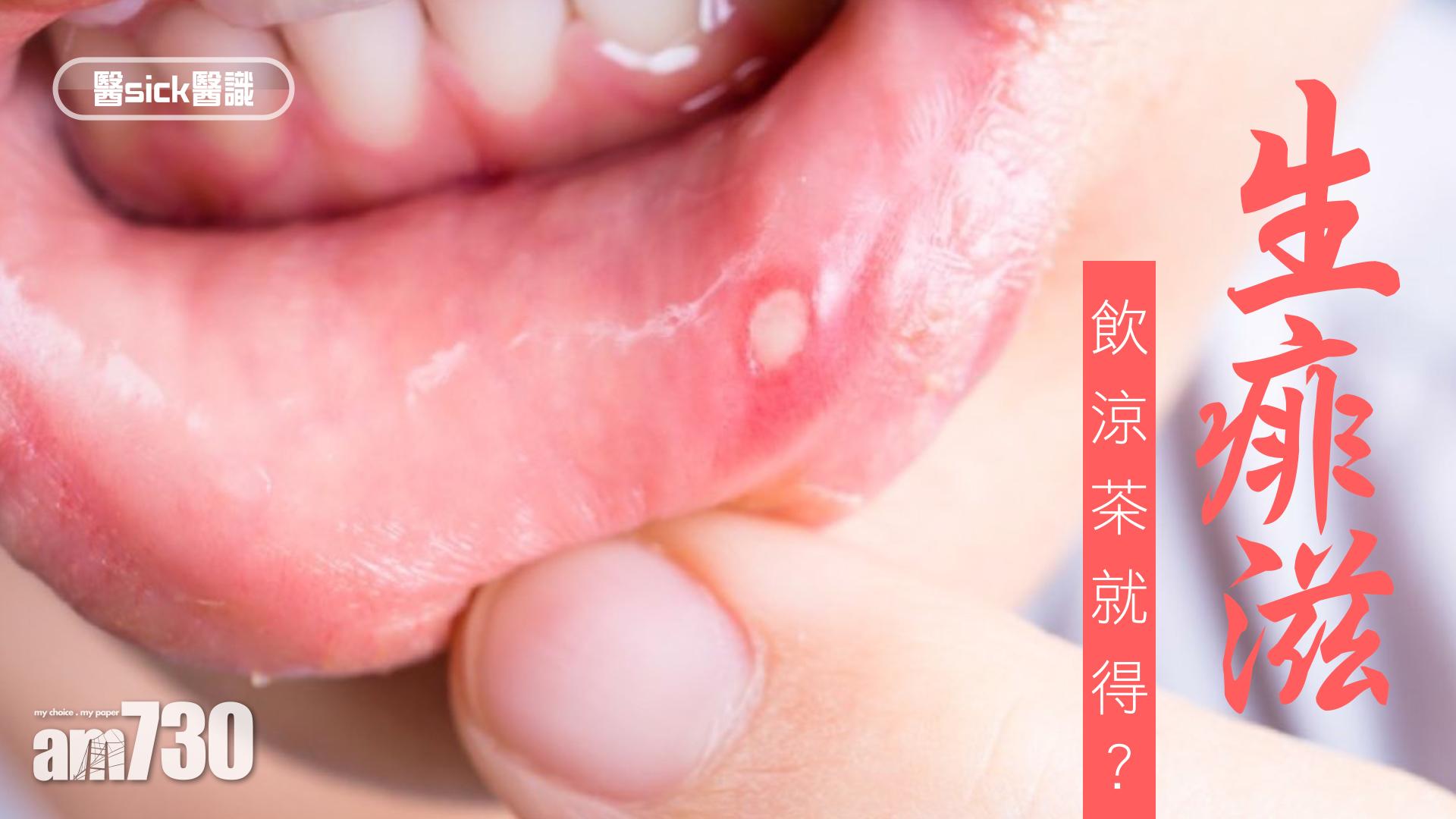 生痱滋 飲涼茶就得？