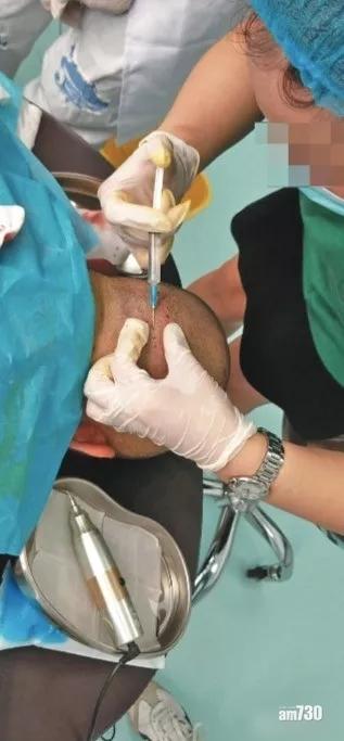 北京驚現3日植髮速成班 醫生：操作失誤可致死