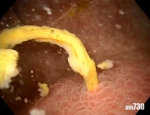 【咁嘅？】七旬婦小便有氣泡  原來糞便由大腸漏入膀胱