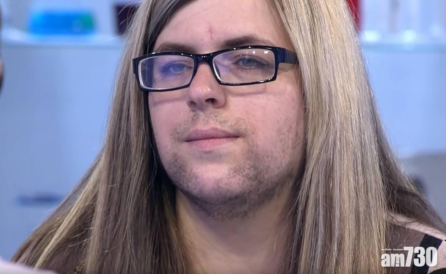 【多毛症】33歲婦滿臉鬚  需戴口罩示人 老公都嫌棄