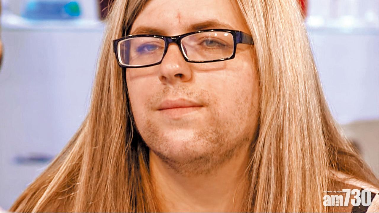 33歲婦多毛症滿臉鬚